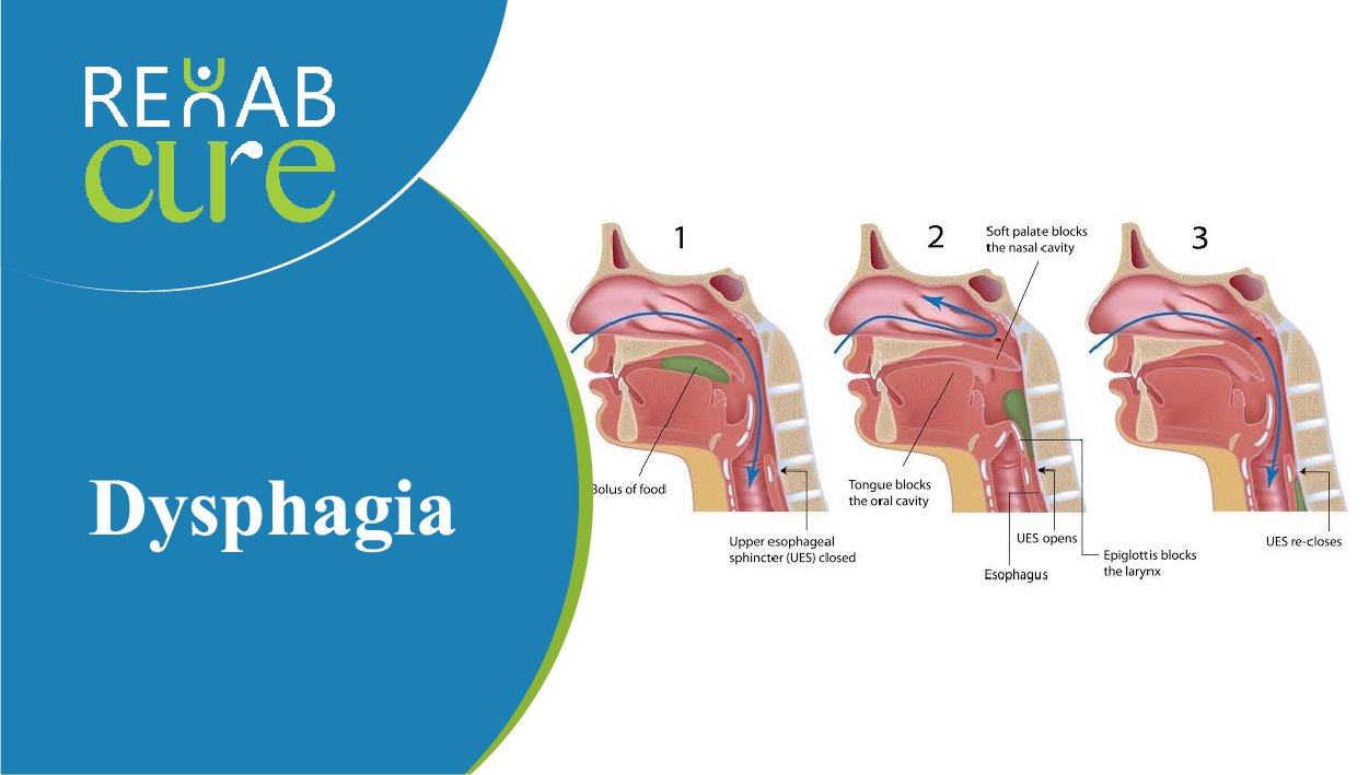 Pas Dysphagia