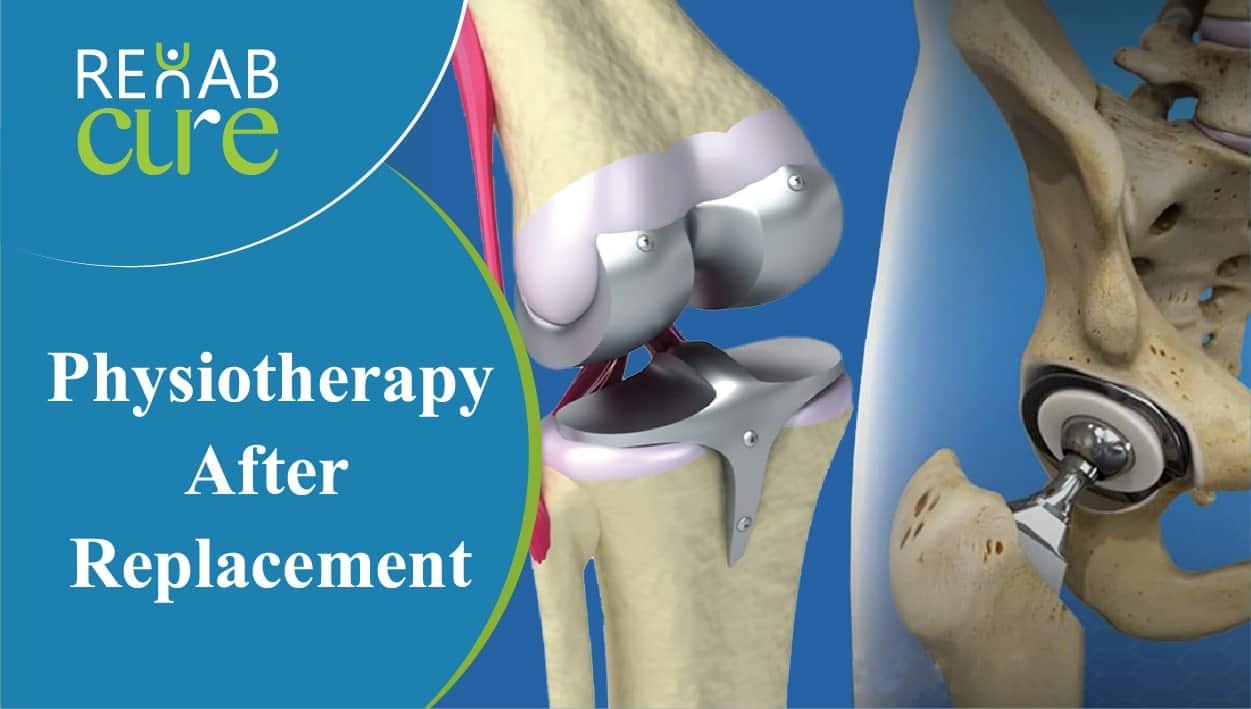 Physiotherapy-After-Replacement