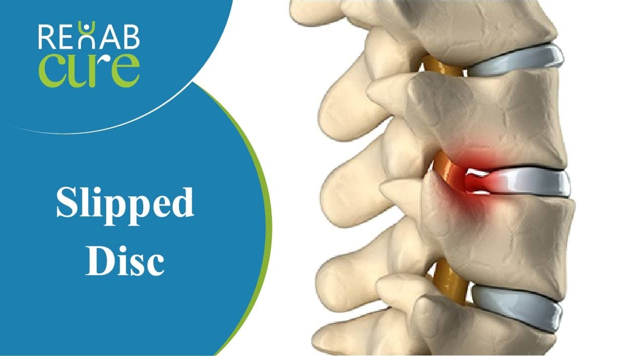 Slipped-Disc-treatment-in-lahore-pakistan